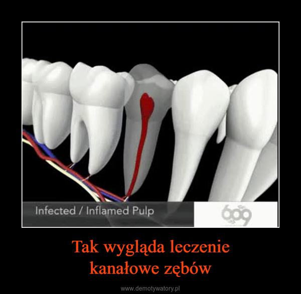 Tak wygląda leczeniekanałowe zębów –  
